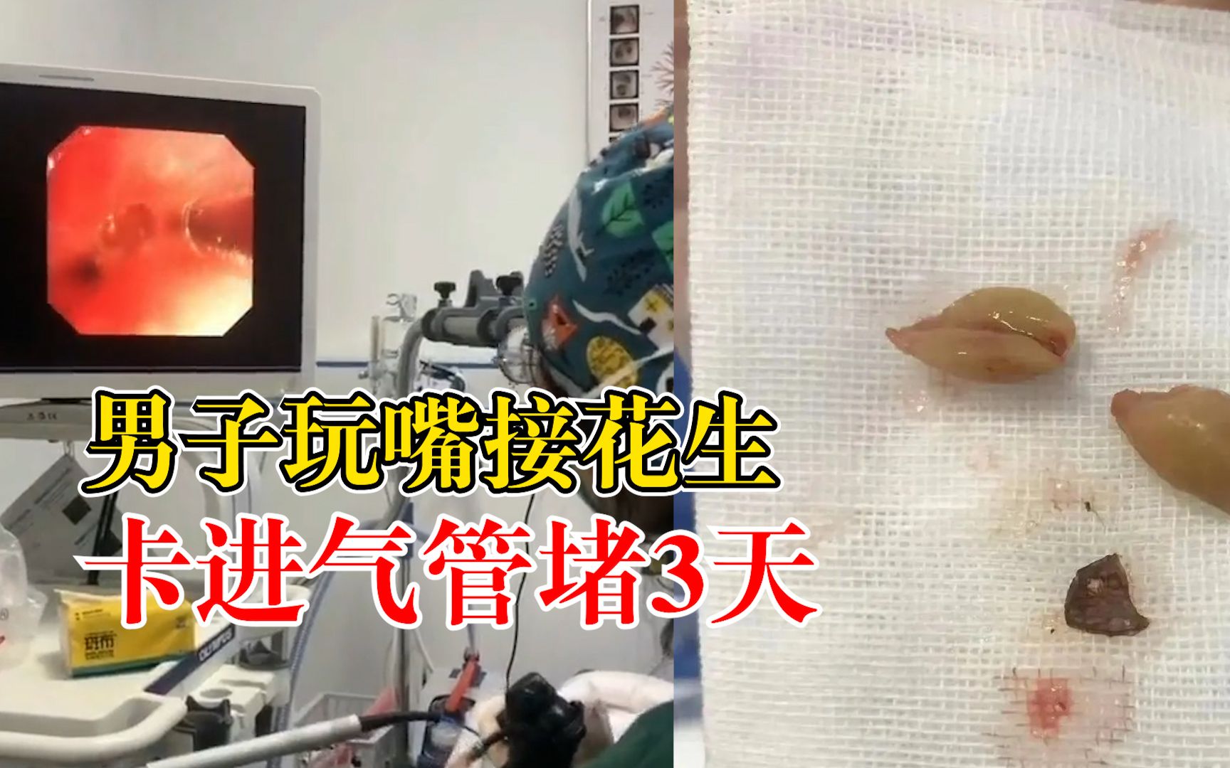 男子玩嘴接花生卡进气管堵3天：出现发热、反复咳嗽才就诊