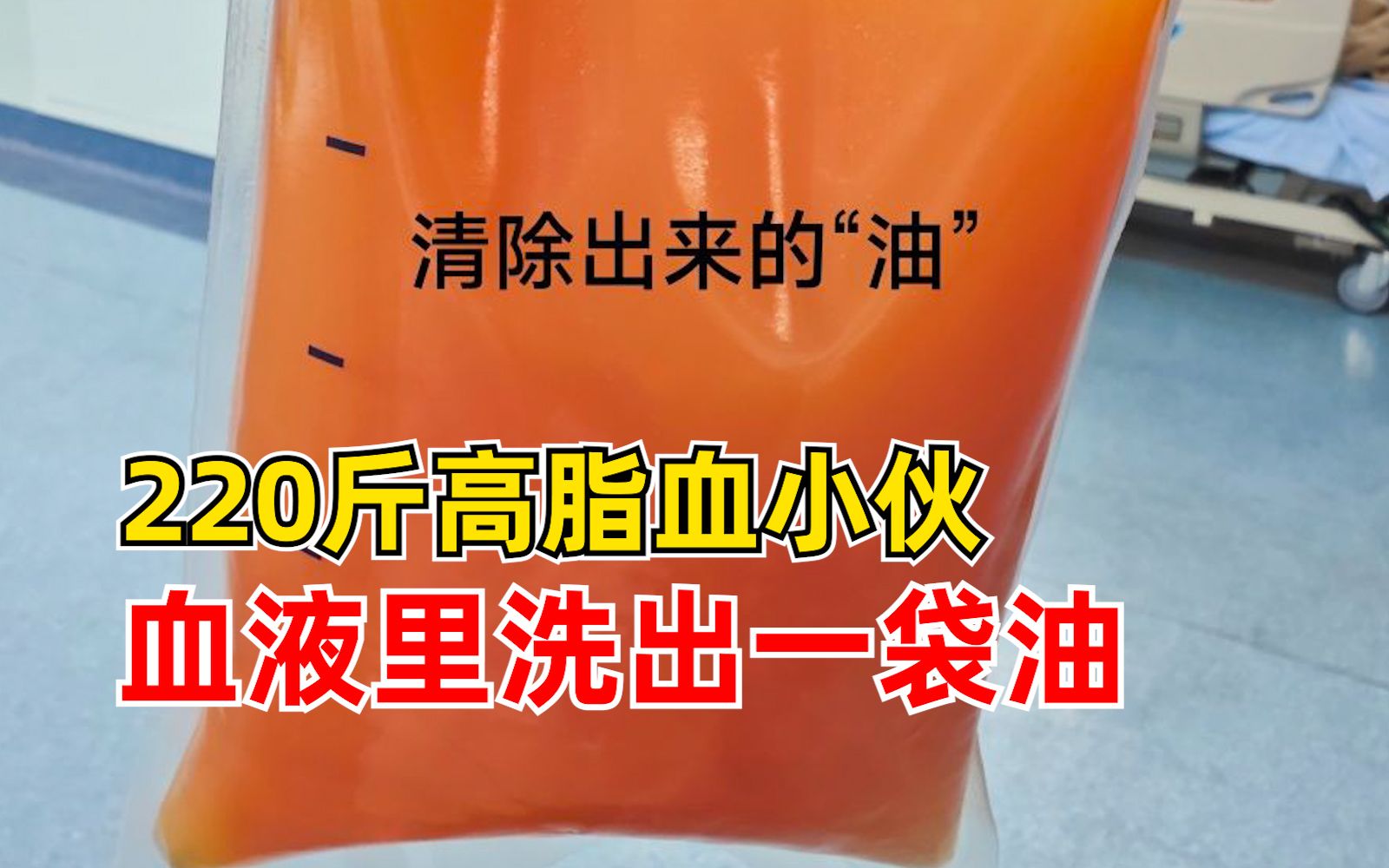 220斤高血脂小伙血液里洗出一袋油：放纵饮食，平时很少运动