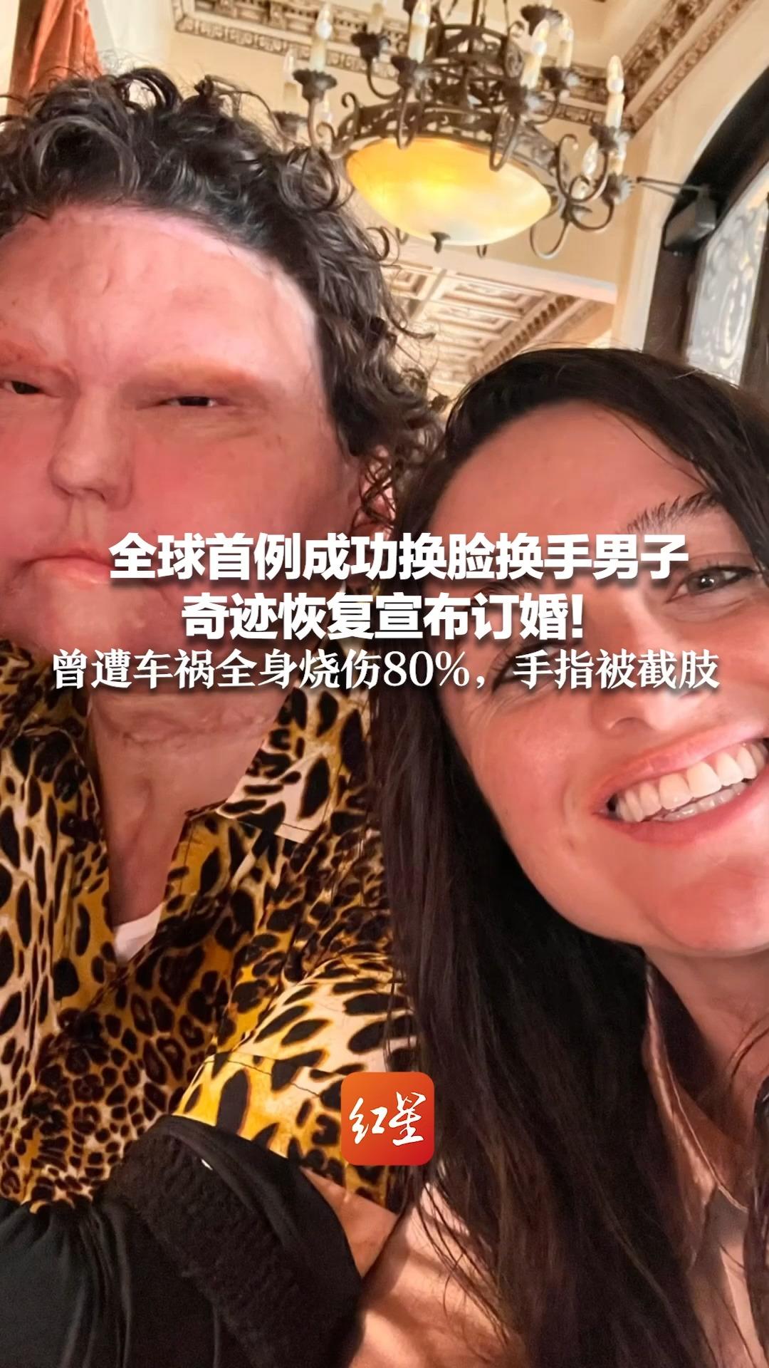 全球首例成功换脸换手男子 奇迹恢复宣布订婚！曾遭车祸全身烧伤80%，手指被截肢