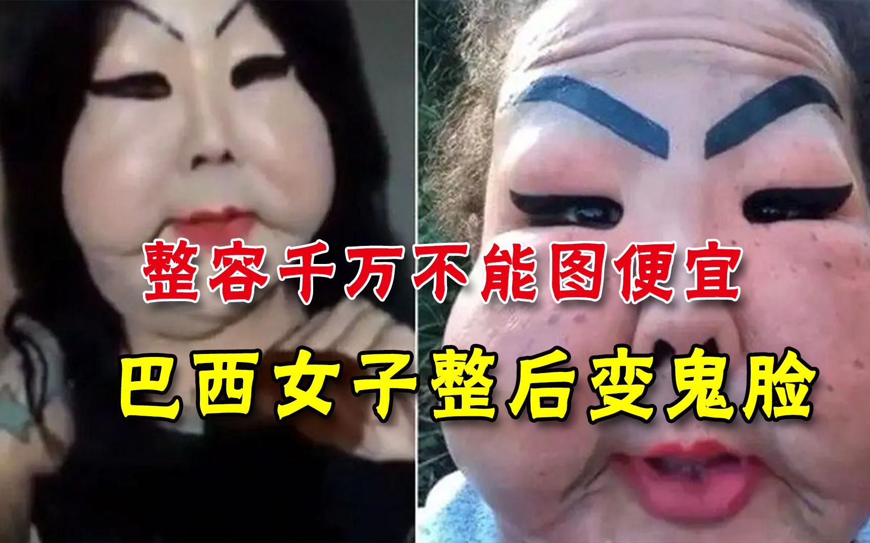 血的教训！巴西女子整形图便宜，小诊所做手术后，整个脸变鬼面具