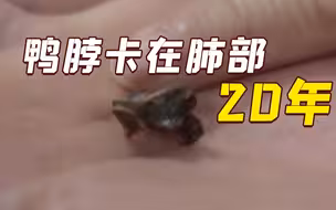 男子啃鸭脖骨头卡进肺部，20年后才被取出
