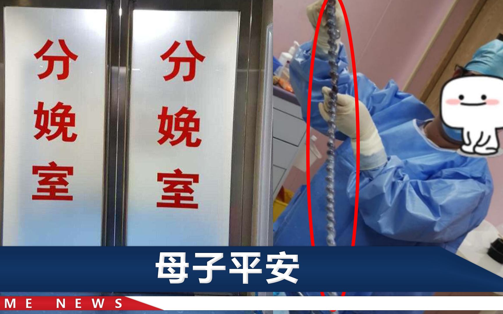 广东一胎儿脐带绕颈5圈，脖子上绕得满满当当，拆开一看一米多长