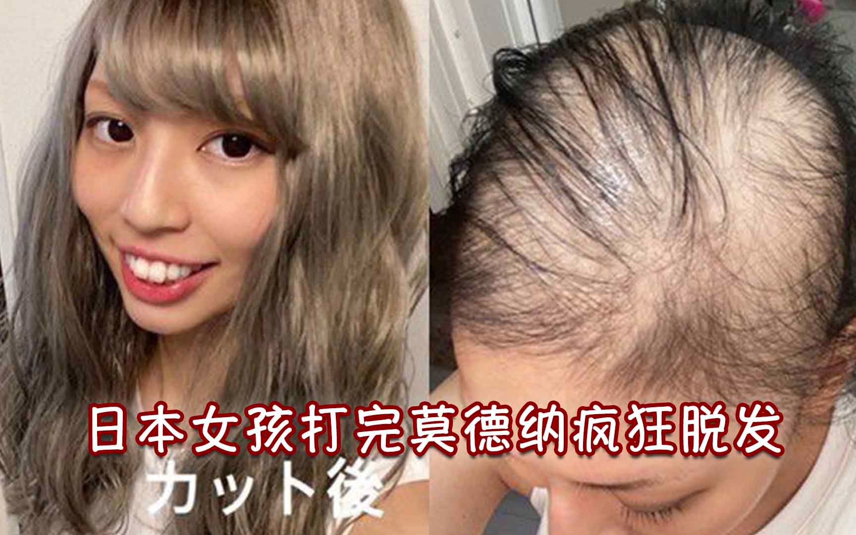 打完莫德纳疯狂脱发！日本女子亲曝全过程 1个月后几乎成光头