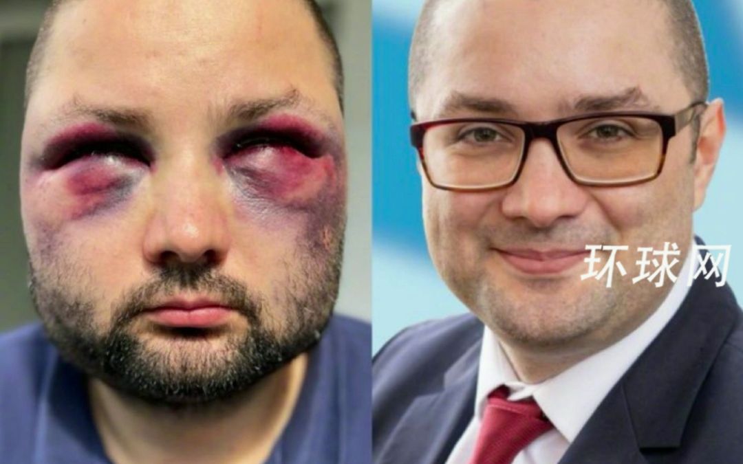 德国反移民政党政客遇袭，被打到鼻青脸肿，直接变熊猫脸