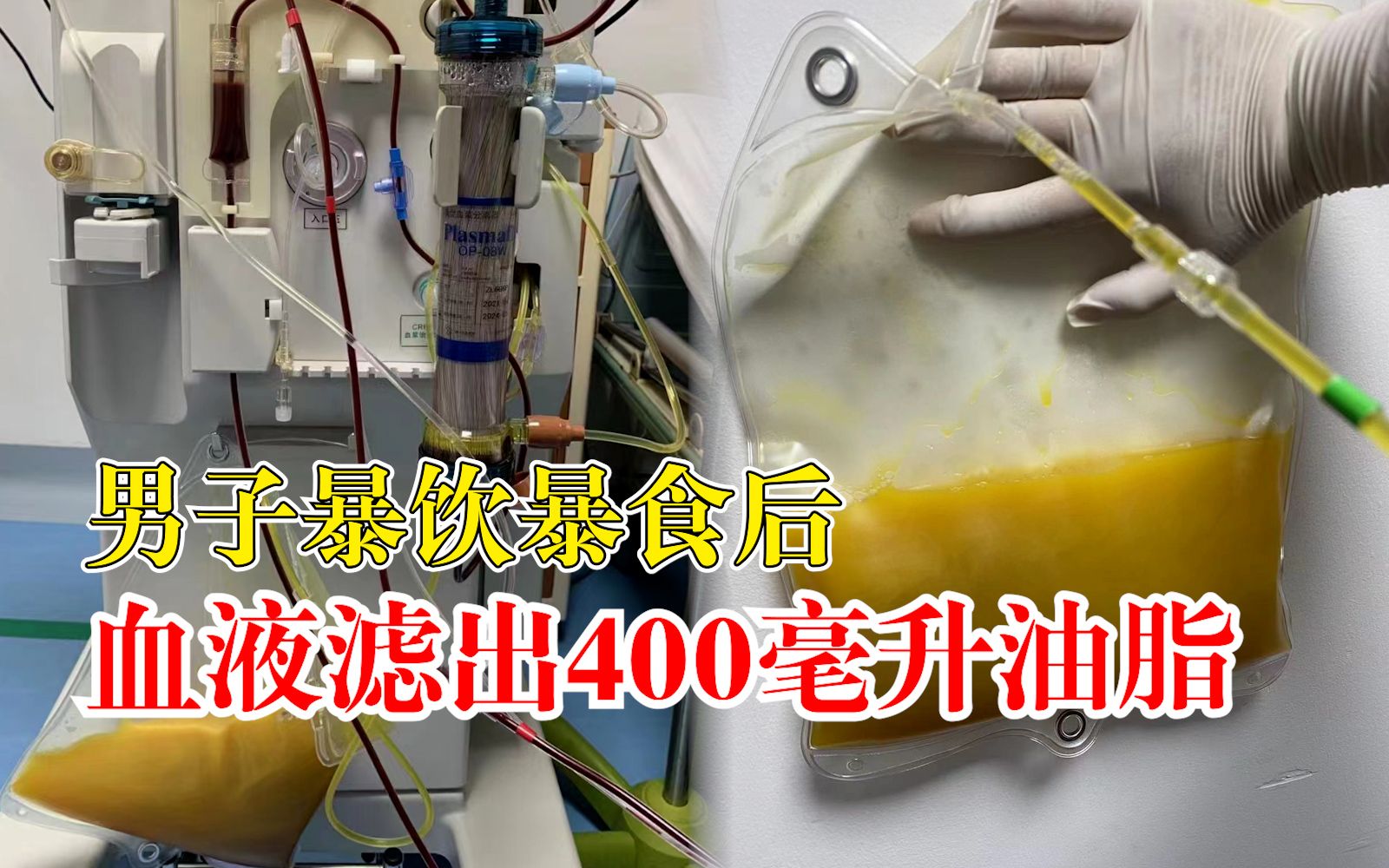 男子暴饮暴食后血液滤出400毫升油脂：甘油三酯严重超标几十倍
