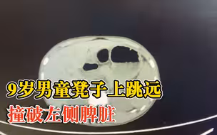 9岁男童凳子上跳远撞破左侧脾脏，医生：腹腔大量积血，切除脾脏