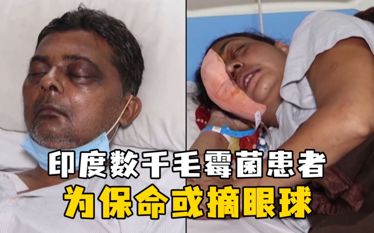 雪上加霜！印度暴发毛霉菌病：数千患者为保命或摘眼球