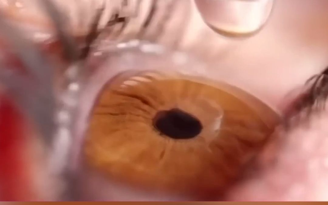 紧急召回！问题眼药水在美致多人失明