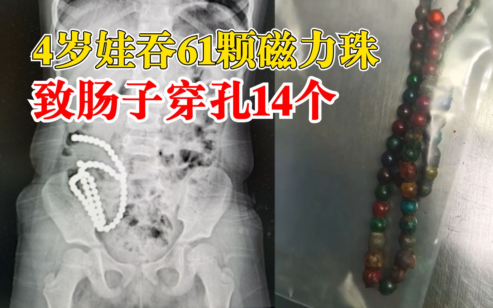 4岁娃吞61颗磁力珠肠子穿孔14个：每次吞几颗，积累了一个月