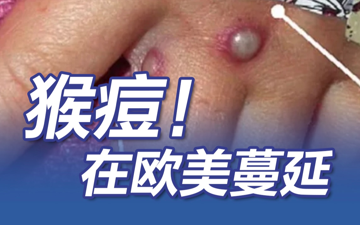 猴痘病例在欧美蔓延！可通过密切接触由动物传染给人