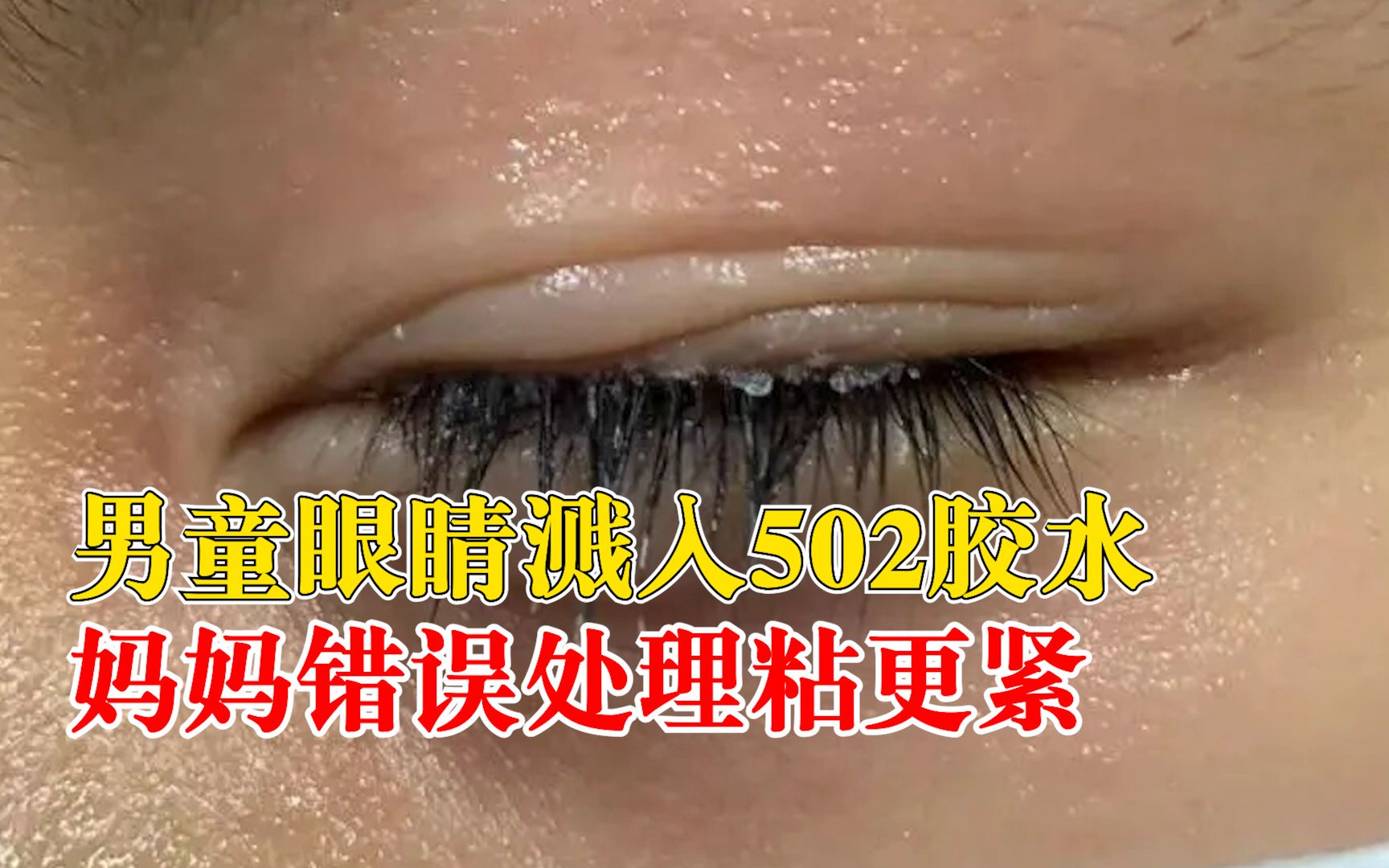 8岁男童做手工眼睛被502胶水粘住，妈妈一番操作促使粘得更紧