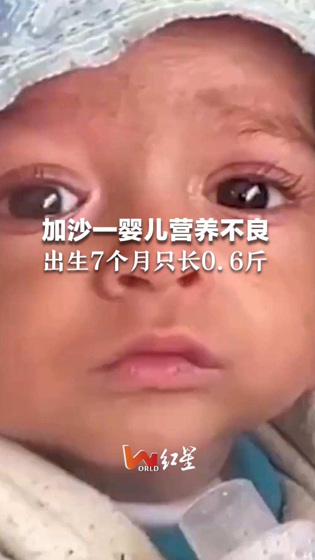 加沙一婴儿营养不良 出生7个月只长0.6斤 母亲：没有干净水 用雨水冲奶粉