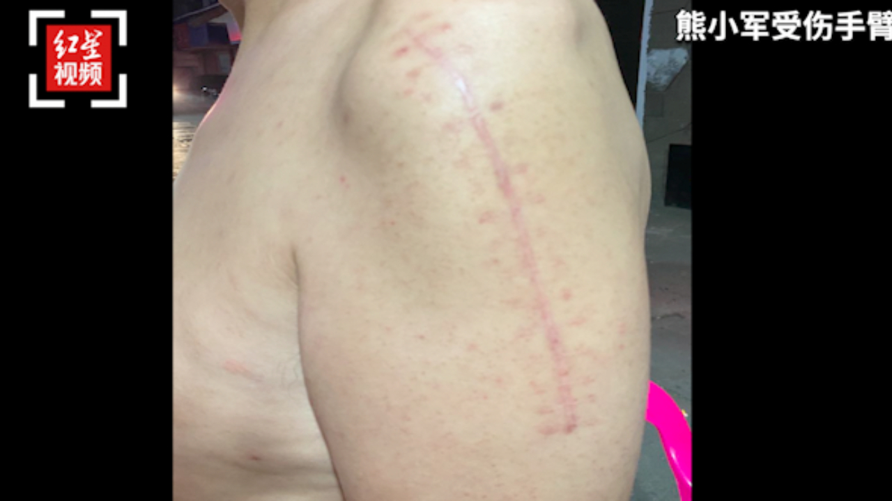 “男子把戴口罩路人打骨折”案二审 伤人者：喝了酒，有点上头