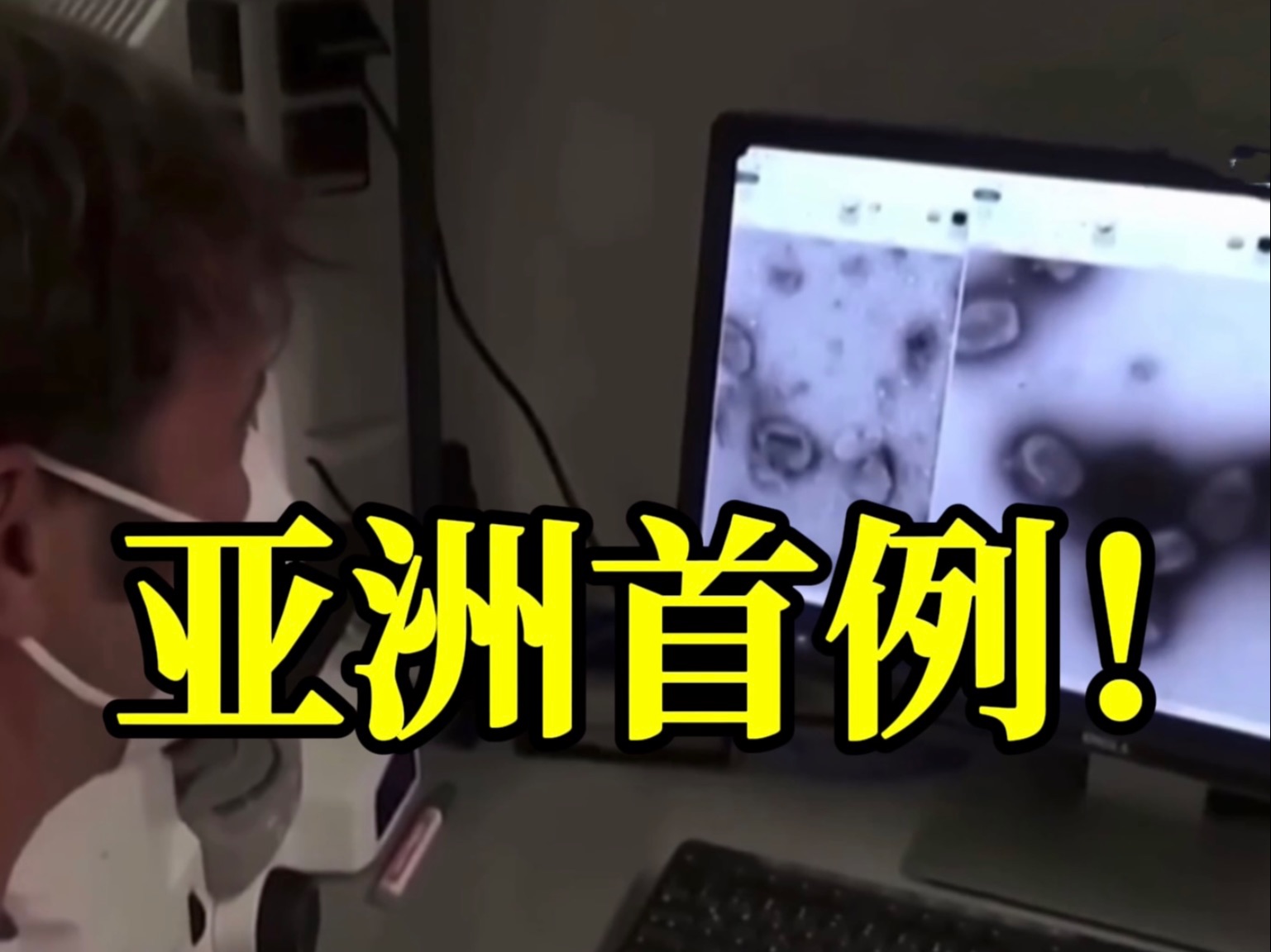 亚洲首例！猴痘变异新毒株出现，可飞沫传播