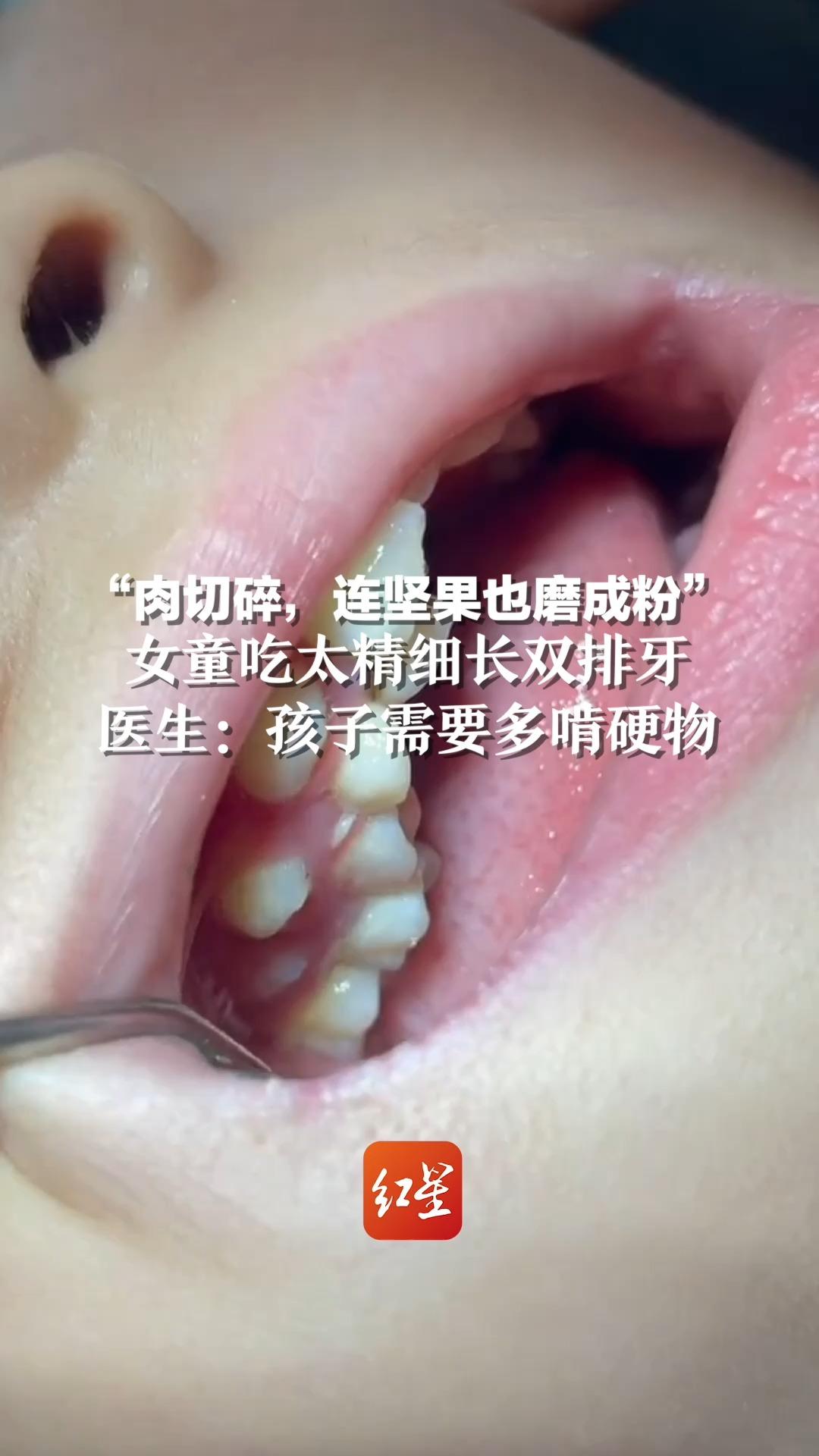 “肉切碎，连坚果也磨成粉”女童吃太精细长双排牙，医生：孩子需要多啃硬物