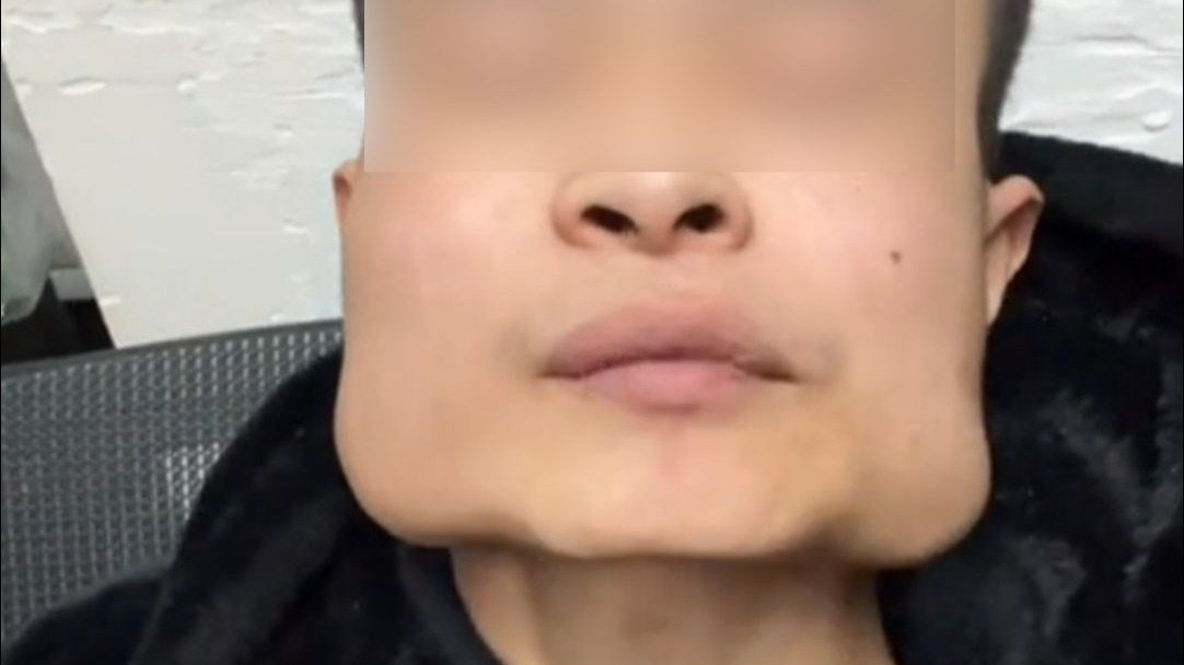 小伙嚼槟榔变“国字脸”，想通过葛根戒掉槟榔，医生：葛根有一定作用 需找医生判断是否适合
