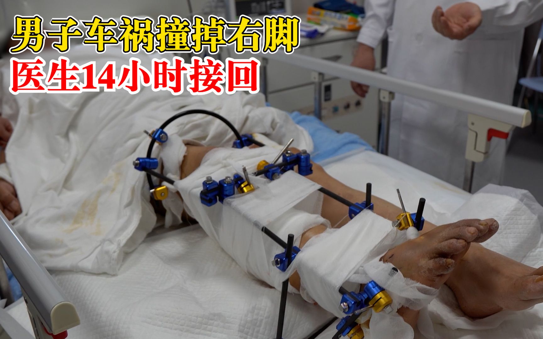 男子车祸撞掉右脚医生14小时接回：送医及时，同时进行3个手术