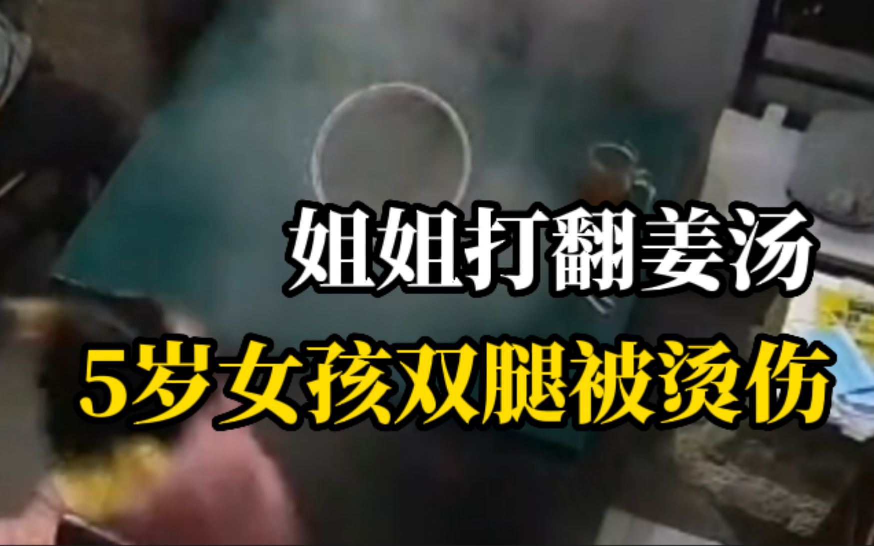 姐姐不小心打翻滚烫的姜汤，5岁女孩双腿被烫伤