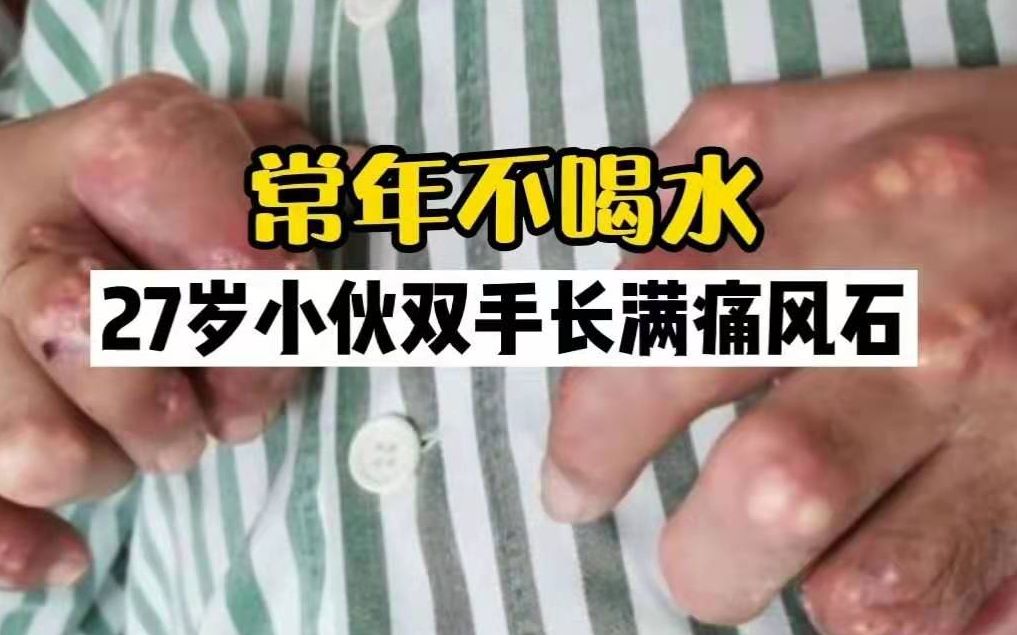 痛风呈年轻化！27岁小伙饮料当水喝双手长满痛风石