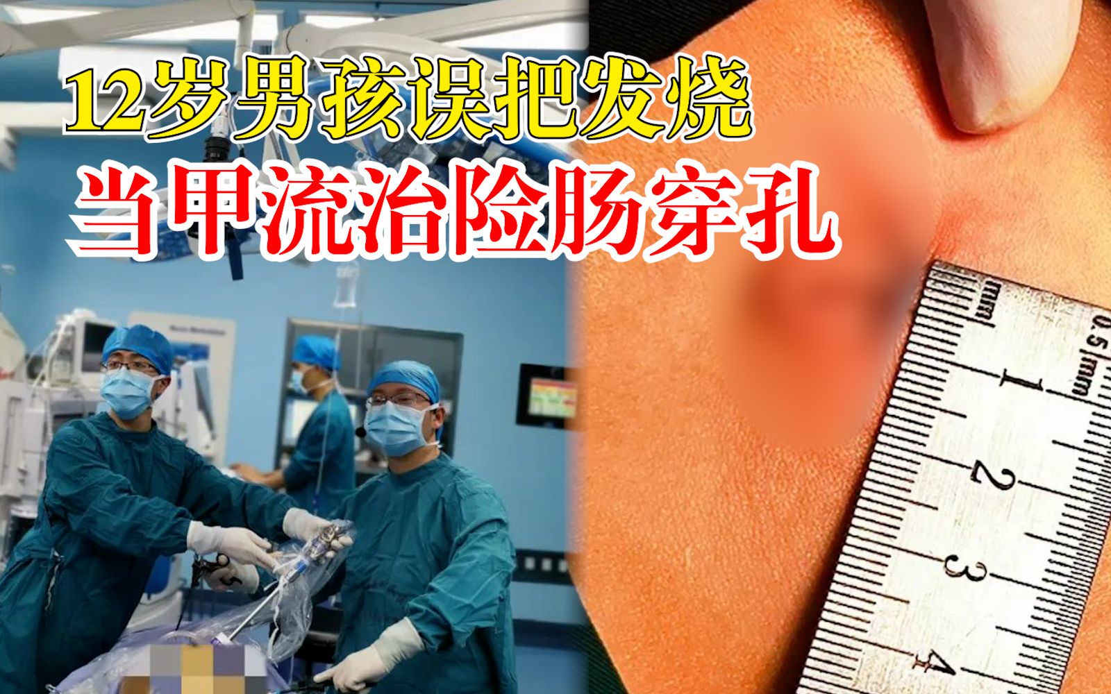 12岁男孩误把发烧当甲流险肠穿孔：急性阑尾炎，阑尾已化脓