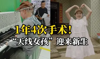 严重脊柱侧弯女孩术后“长高”22厘米，身高从128厘米长到了150厘米