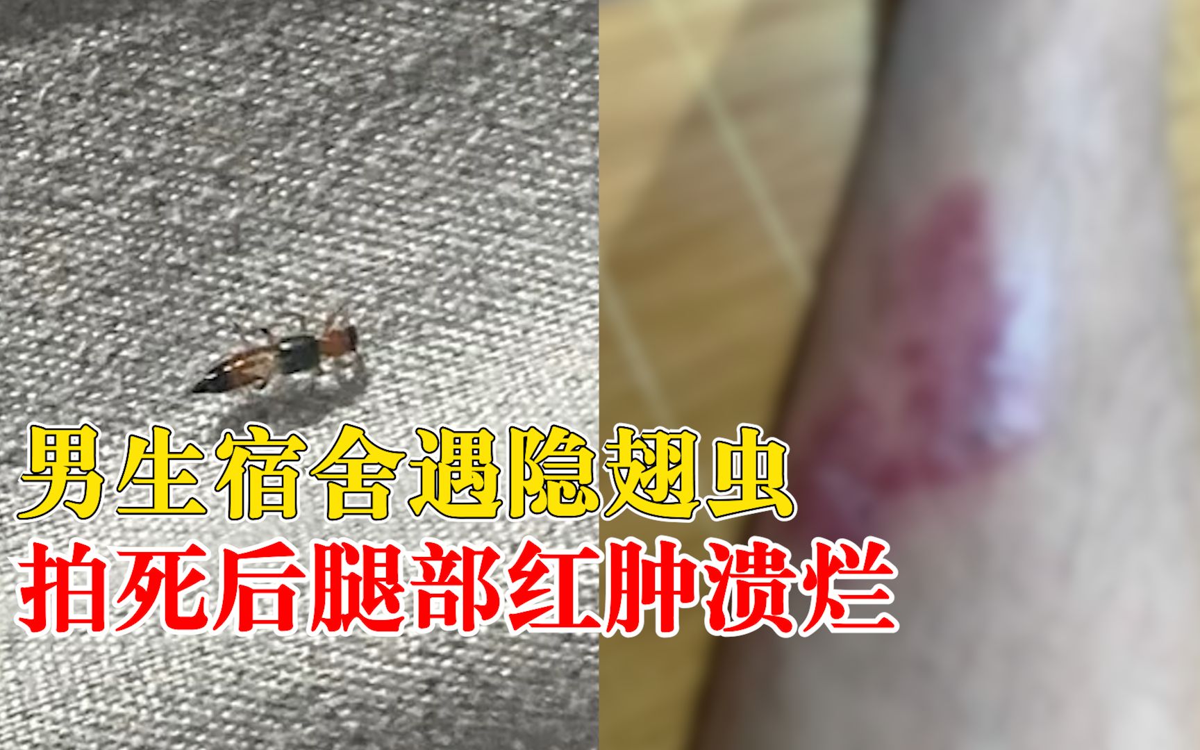 男生拍死隐翅虫后腿部溃烂红肿：感觉像火烧一样