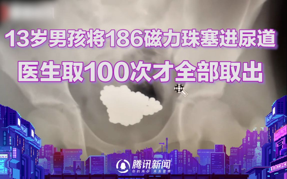 13岁男孩将186磁力珠塞进尿道，医生取100次才全部取出！