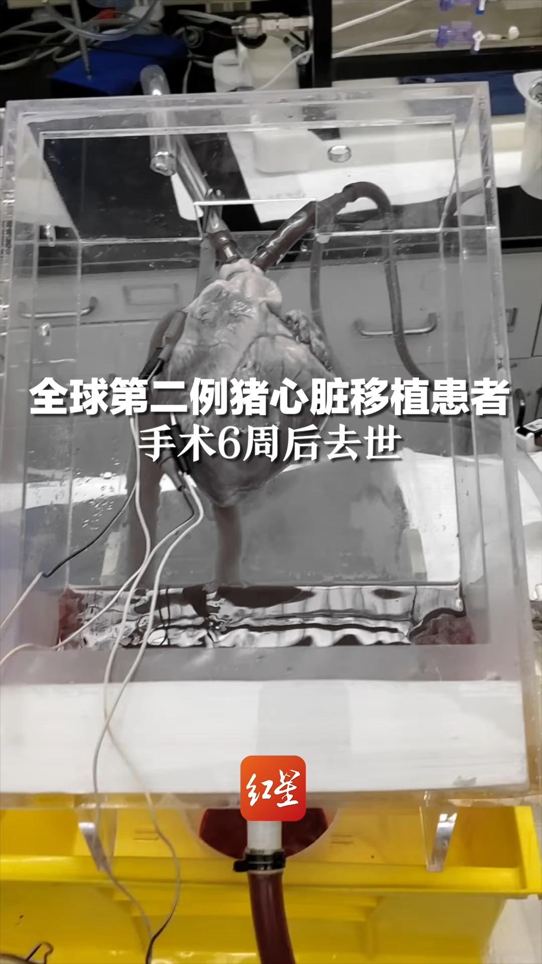 全球第二例猪心脏移植患者，手术6周后去世，第一例也仅存活两个月