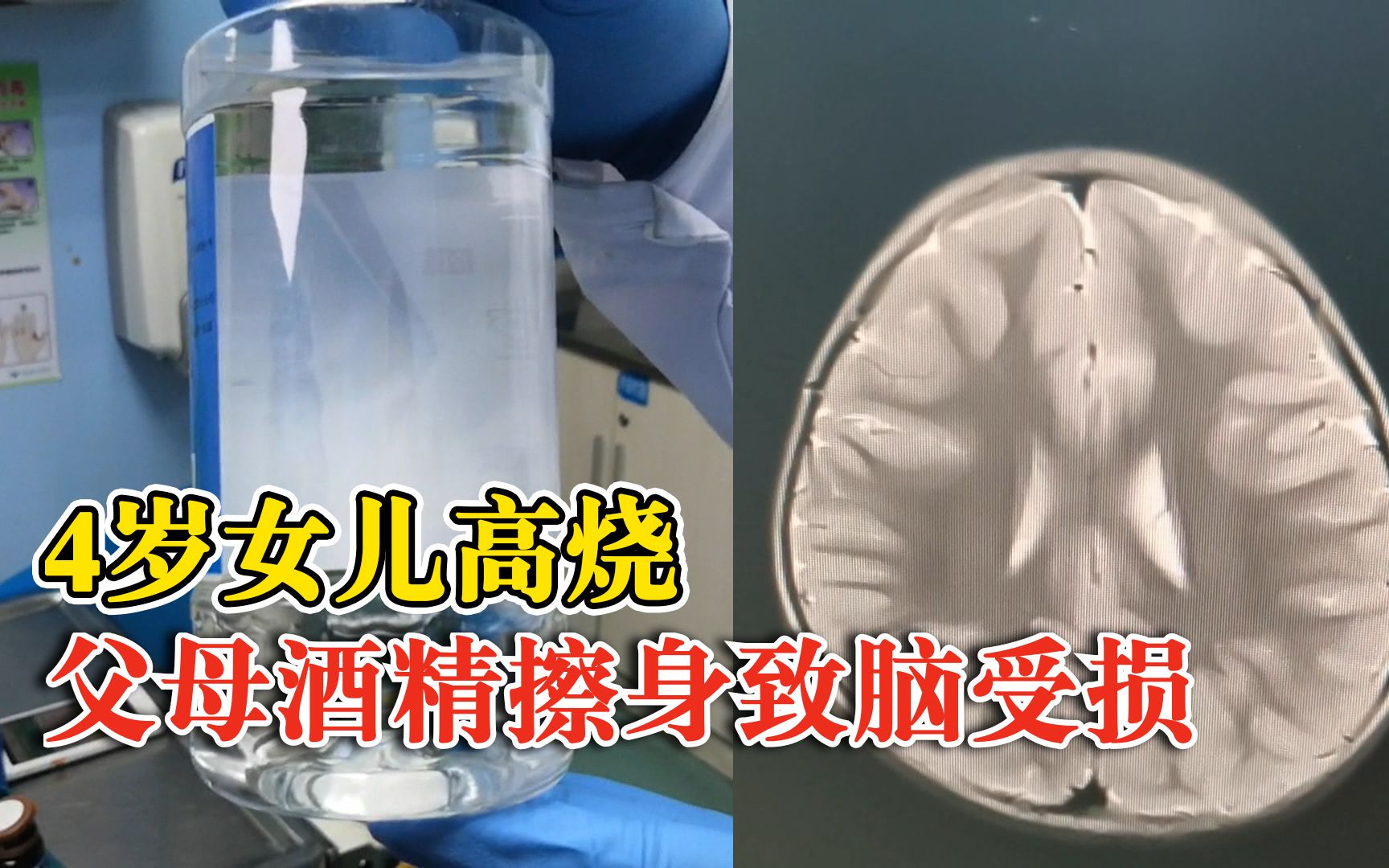 父母抹酒精退烧致4岁女儿住进ICU：酒精渗入皮肤引发急性酒精中毒