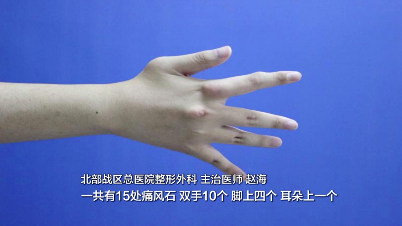 天天吃麻辣烫喝饮料 19岁小伙全身长了15颗“痛风石”