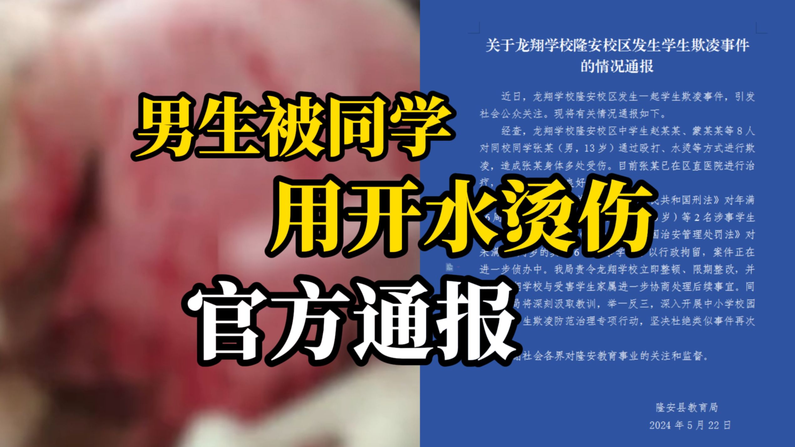 广西龙翔学校13岁男生遭同学8人开水烫伤霸凌，官方通报：2人刑拘 6人行拘