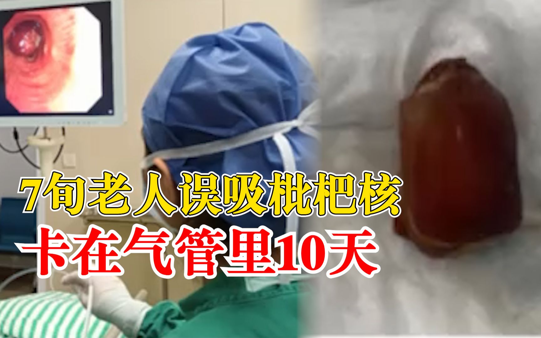 7旬老人误吸枇杷核取出时快发芽：1厘米多，卡在气管里10天