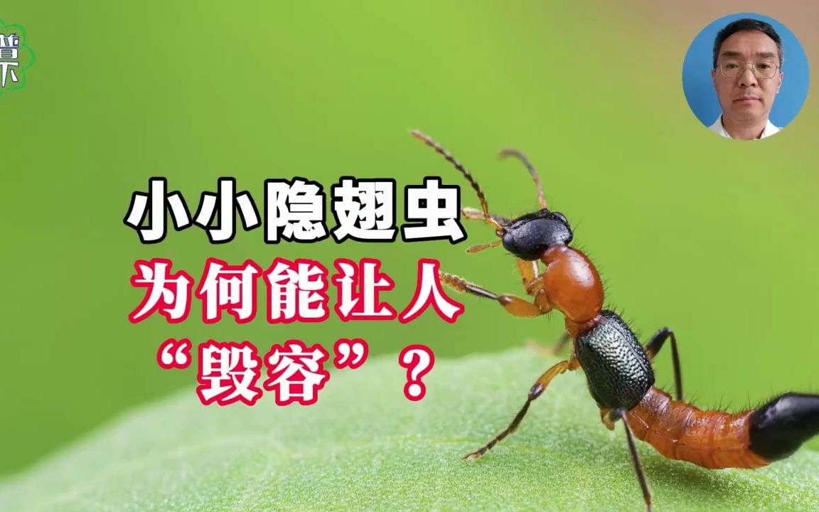 隐翅虫为何能让人毁容？