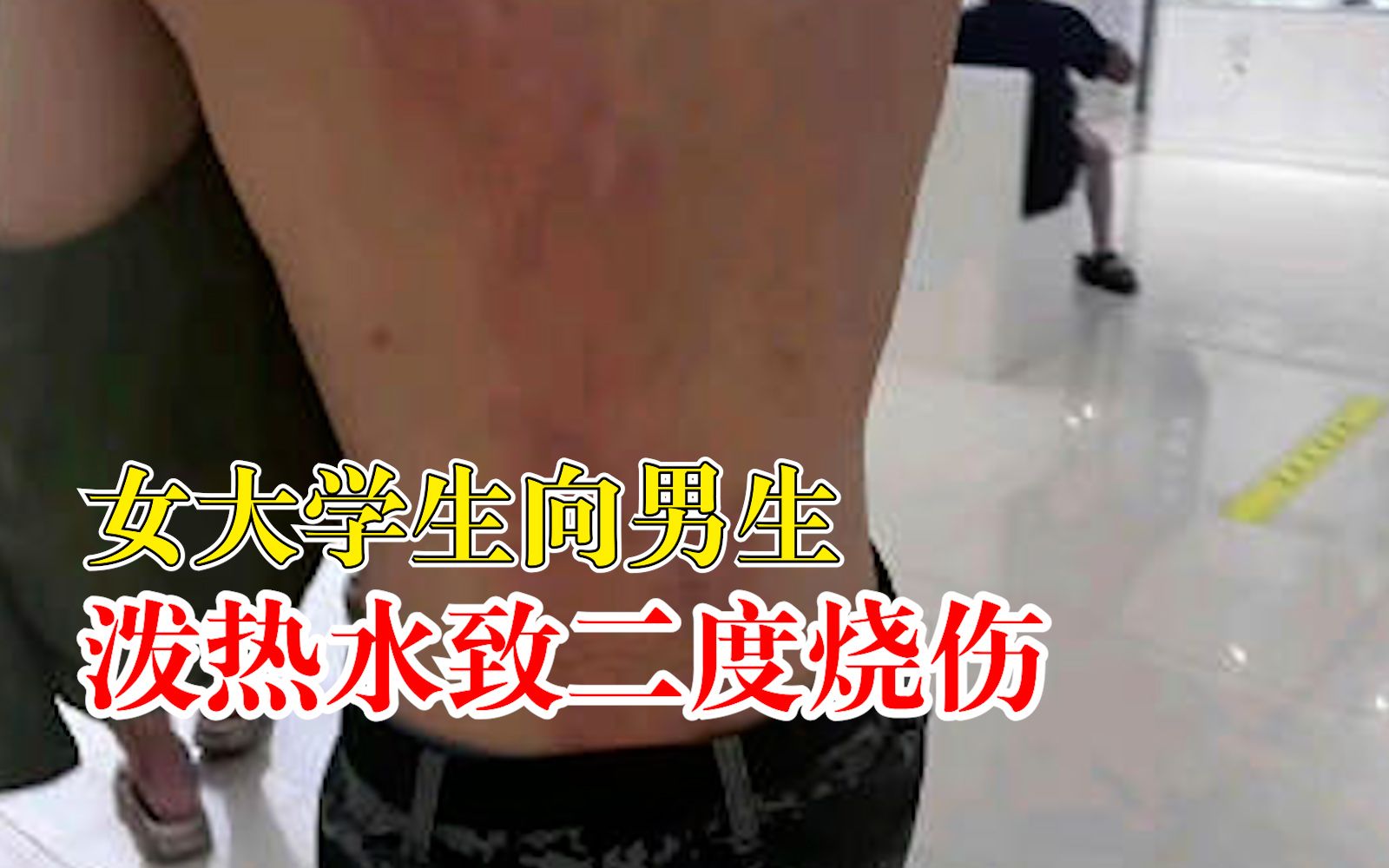 女大学生向男生泼热水致二度烧伤，校方：女生已道歉，双方和解