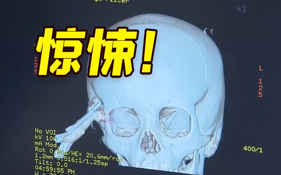 上海一名5岁女童玩耍时从床上跌落 剪刀插入脑颅2公分