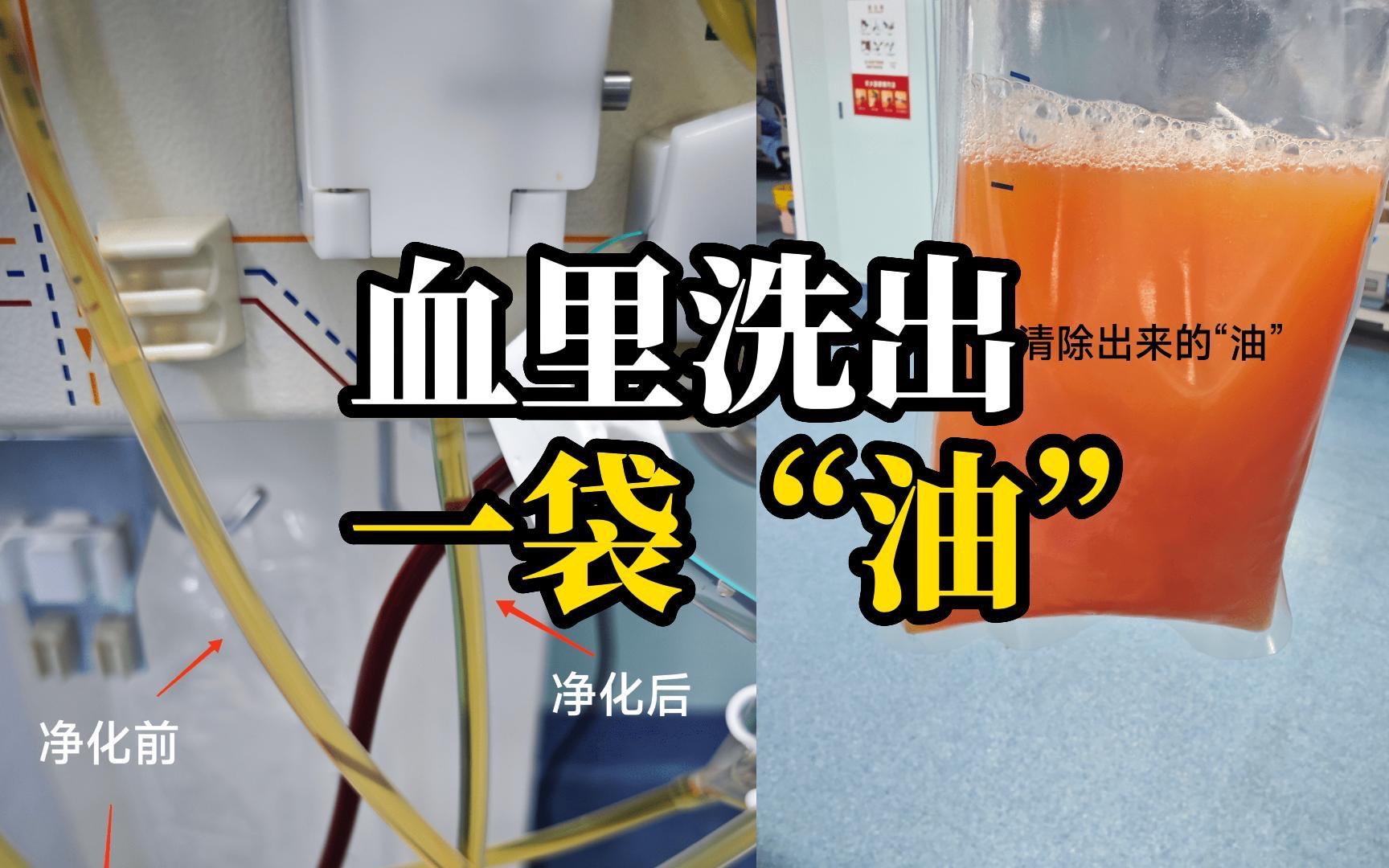 23岁男子血液里洗出一大袋“油” 平时运动少 爱吃大鱼大肉
